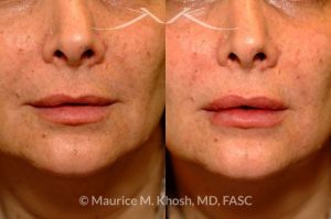 Photo of a patient before and after a procedure. Lip enhancement with Juvaderm