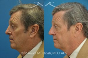 Photo of a patient before and after a procedure. Revision open approach rhinoplasty with septum cartilage graft - Previous rhinoplasty in this gentleman had caused nasal obstruction, pinched and retracted nostrils, and excess columellar show. Revision open approach rhinoplasty with septum cartilage graft allowed restoration of breathing, and creation of a natural and harmonious appearing nose.