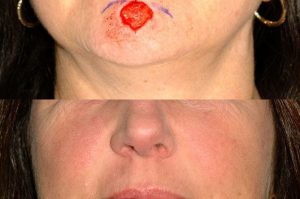 Photo of a patient before and after a procedure. Chin repair utilizing the O T advancement technique