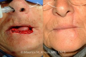 Photo of a patient before and after a procedure. Repair of 60% lower lip defect with Abbe lip switch technique