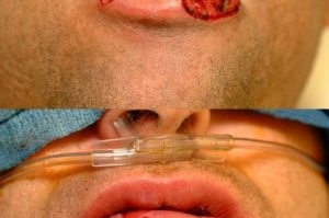 Photo of a patient before and after a procedure. Lower lip repair with advancement flaps
