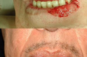 Photo of a patient before and after a procedure. Repair of lower lip defect with lining flap from inside the mouth