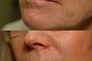 Photo of a patient before and after a procedure. Upper lip repair with advancement flaps