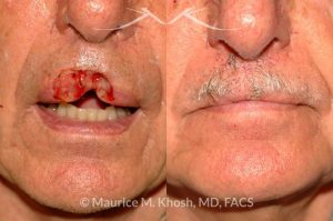 Photo of a patient before and after a procedure. Upper lip repair with bilateral davancement flaps