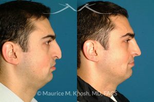 Photo of a patient before and after a procedure. Revision rhinoplasty via an open approach, utilizing cartilage graft - Patient with cleft lip nasal deformity. Previous rhinoplasty had been unsuccessful at restoring the droopy tip and asymmetric nasal tip. Revision rhinoplasty via an open approach, utilizing cartilage grafts successfully elevated the nasal tip and achieved tip symmetry.