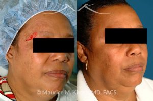 Photo of a patient before and after a procedure. Repair of brow defect