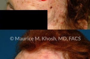 Photo of a patient before and after a procedure. Repair of large forehead defect