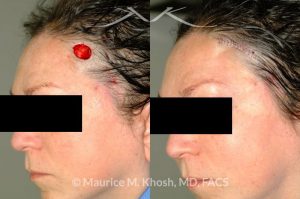 Photo of a patient before and after a procedure. Repair of lateral forehead defect
