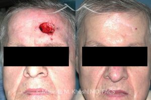 Photo of a patient before and after a procedure. Repair of left forehead defect