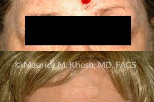 Photo of a patient before and after a procedure. Repair of mid forehead defect