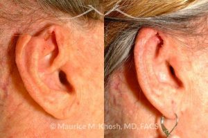 Photo of a patient before and after a procedure. Advancement flap for repair of rim defect