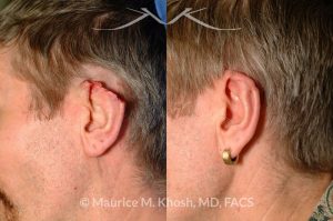 Photo of a patient before and after a procedure. Skin flap form posterior aspect of ear to repair large rim defect