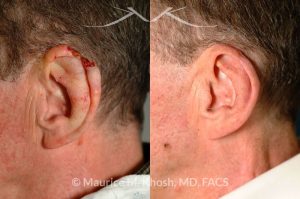 Photo of a patient before and after a procedure. Repair of helical rim with advancement flap