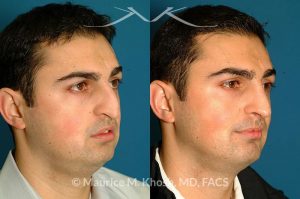 Photo of a patient before and after a procedure. Patient with cleft lip nasal deformity. Previous rhinoplasty had been unsuccessful at restoring the droopy tip and asymmetric nasal tip. Revision rhinoplasty via an open approach, utilizing cartilage grafts successfully elevated the nasal tip and achieved tip symmetry.