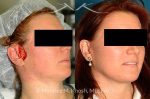 Photo of a patient before and after a procedure. Lateral cheek Mohs defect repaired with a facelift flap