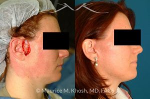 Photo of a patient before and after a procedure. Lateral cheek Mohs defect repaired with a facelift flap