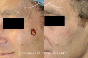 Photo of a patient before and after a procedure. Medium sized Mohs defect of cheek repaired with local flap