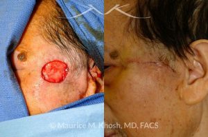 Photo of a patient before and after a procedure. Upper cheek and temple reconstruction with mustarde advancement flap