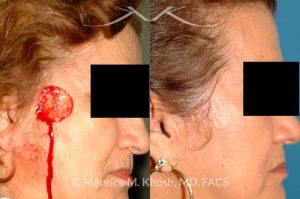 Photo of a patient before and after a procedure. Mohs cancer defect of the face - Upper cheek & temple reconstruction with mustarde cheek advancement.