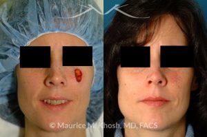 Photo of a patient before and after a procedure. Mohs defect of the central cheek repaired with bilateral local advancement flaps