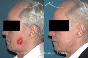 Photo of a patient before and after a procedure. Mohs defect of the lower cheek with a transposition flap