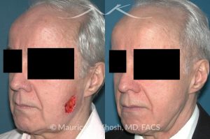 Photo of a patient before and after a procedure. Mohs defect of the lower cheek with a transposition flap