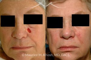 Photo of a patient before and after a procedure. Mohs defect of the medial cheek repaired with a local advancement flap