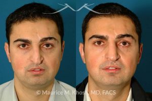 Photo of a patient before and after a procedure. Revision rhinoplasty via an open approach, utilizing cartilage grafts - Patient with cleft lip nasal deformity. Previous rhinoplasty had been unsuccessful at restoring the droopy tip and asymmetric nasal tip. Revision rhinoplasty via an open approach, utilizing cartilage grafts successfully elevated the nasal tip and achieved tip symmetry.