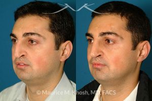 Photo of a patient before and after a procedure. Revision rhinoplasty via an open approach, utilizing cartilage graft - Patient with cleft lip nasal deformity. Previous rhinoplasty had been unsuccessful at restoring the droopy tip and asymmetric nasal tip. Revision rhinoplasty via an open approach, utilizing cartilage grafts successfully elevated the nasal tip and achieved tip symmetry.