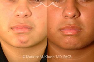 Photo of a patient before and after a procedure. Scar revision of the chin