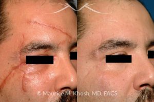 Photo of a patient before and after a procedure. Scar revision of forehad and upper face