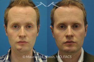 Photo of a patient before and after a procedure. Scar revision of the chin due to traumatic chin laceration