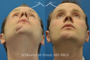 Photo of a patient before and after a procedure. Scar revision of the chin due to traumatic chin laceration