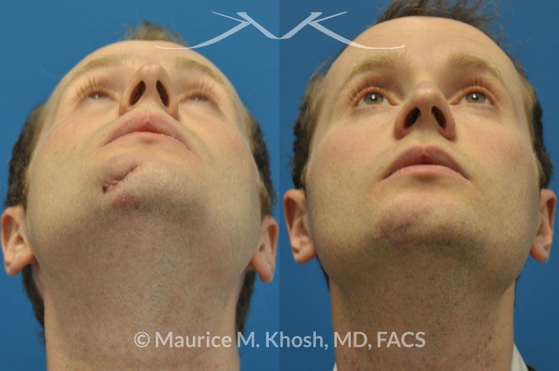 New York Facial Plastic Surgery Scar Revision Laceration Repair