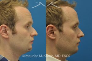 Photo of a patient before and after a procedure. Scar revision of the chin due to traumatic chin laceration