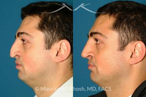 Photo of a patient before and after a procedure. Revision rhinoplasty via an open approach, utilizing cartilage graft - Patient with cleft lip nasal deformity. Previous rhinoplasty had been unsuccessful at restoring the droopy tip and asymmetric nasal tip. Revision rhinoplasty via an open approach, utilizing cartilage grafts successfully elevated the nasal tip and achieved tip symmetry.