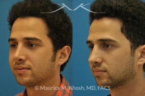 Photo of a patient before and after a procedure. Revision rhinoplasty via the open approach - Previous rhinoplasty in this young man had been a failure. The tip was raised too high, the nose was too short, and the tip was pinched. Revision rhinoplasty via the open approach successfully addressed the abnormalities and rendered the nose more aesthetic and natural in its appearance.