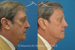 Photo of a patient before and after a procedure. Nasal valve stenosis