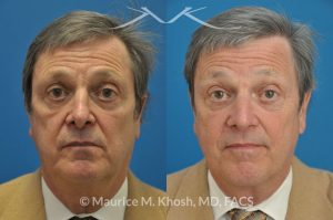 Photo of a patient before and after a procedure. Nasal valve stenosis