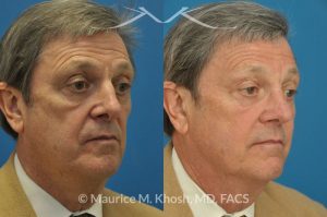 Photo of a patient before and after a procedure. Nasal valve stenosis