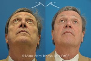 Photo of a patient before and after a procedure. Nasal valve stenosis