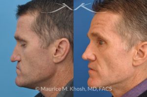 Photo of a patient before and after a procedure. Nasal valve repair with rib cartilage graft