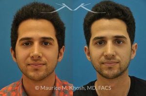 Photo of a patient before and after a procedure. Revision rhinoplasty via the open approach - Previous rhinoplasty in this young man had been a failure. The tip was raised too high, the nose was too short, and the tip was pinched. Revision rhinoplasty via the open approach successfully addressed the abnormalities and rendered the nose more aesthetic and natural in its appearance.