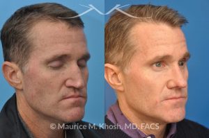 Photo of a patient before and after a procedure. Nasal valve repair with rib cartilage graft