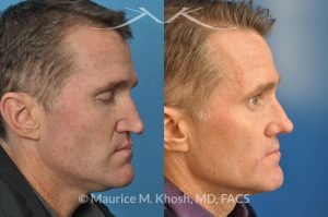 Photo of a patient before and after a procedure. Nasal valve repair with rib cartilage graft