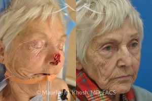 Photo of a patient before and after a procedure. Nose Mohs skin cancer repair, utilizing forehead flap and ear cartilage graft - before and after photos.