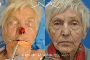 Photo of a patient before and after a procedure. Nose Mohs skin cancer repair, utilizing forehead flap and ear cartilage graft - before and after photos.