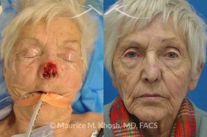 Photo of a patient before and after a procedure. Nose Mohs skin cancer repair, utilizing forehead flap and ear cartilage graft - before and after photos.