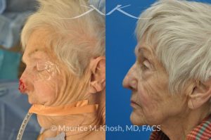 Photo of a patient before and after a procedure. Nose Mohs skin cancer repair, utilizing forehead flap and ear cartilage graft - before and after photos.