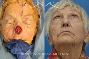 Photo of a patient before and after a procedure. Nose Moh's skin cancer repair, utilizing forehead flap and ear cartilage graft